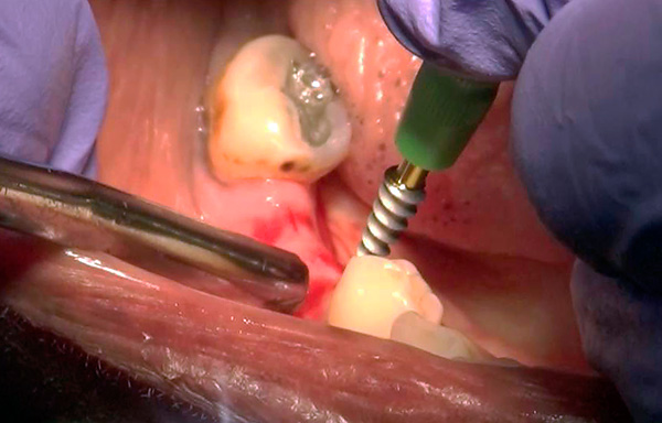 Os implantes basais geralmente podem ser instalados sem incisões gengivais significativas - o método da chamada punção (incisão circular).