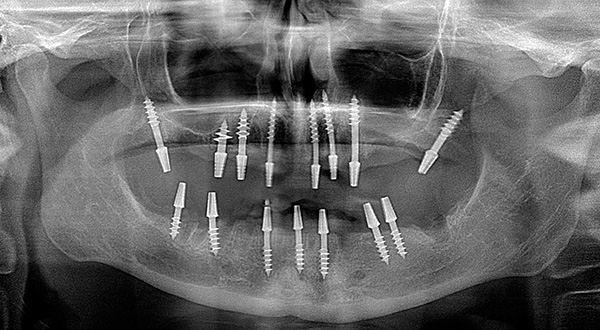 A instalação correta de implantes basais requer um alto nível de treinamento do médico, o que cria certas dificuldades - não é tão fácil encontrar um especialista ...