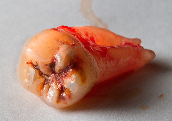 Muitas vezes, um cirurgião-dentista, após a extração do dente, também instala um implante.