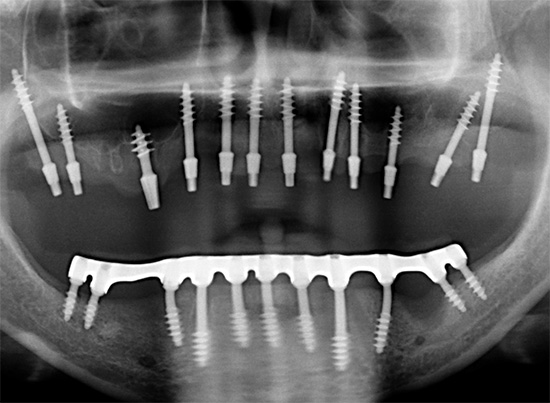 Este raio-x mostra claramente que os implantes basais podem ser bastante longos ...
