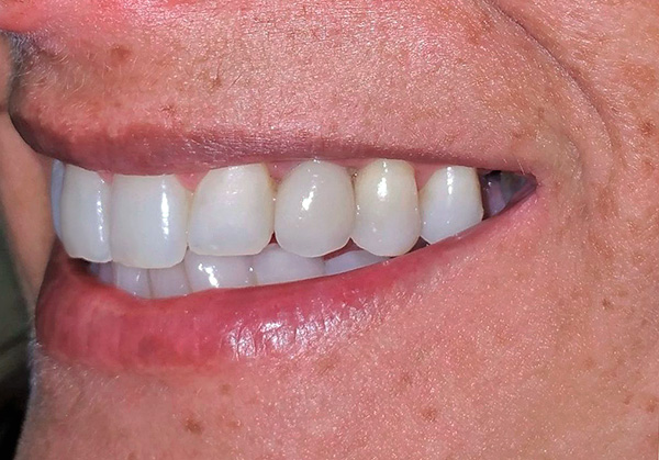 Não importa como você discuta sobre os prós e contras do implante basal, em muitos casos, é realmente uma boa maneira de recuperar rapidamente um sorriso bonito.