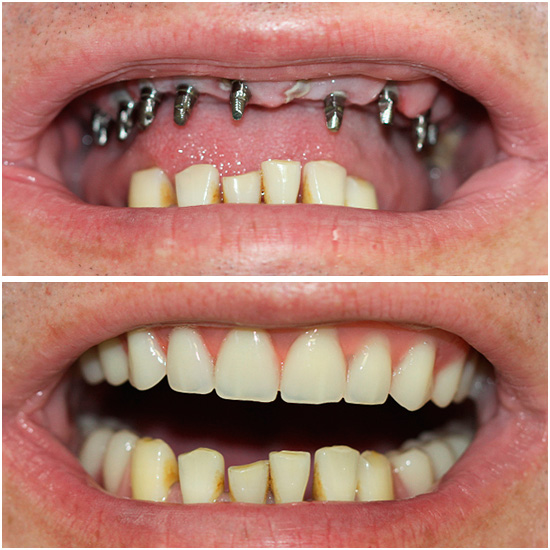 O implante basal realmente tem muitas vantagens - por exemplo, permite retornar rapidamente um belo sorriso a uma pessoa.