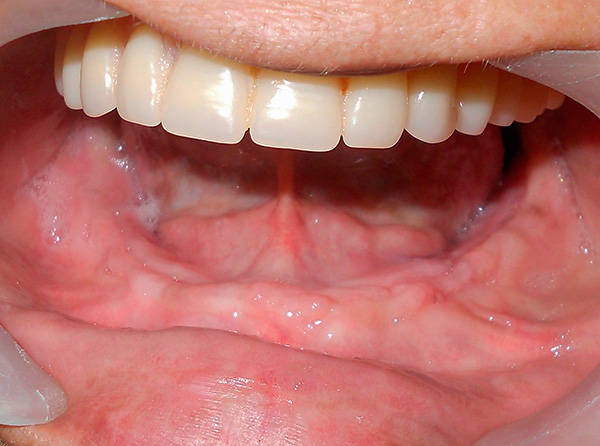 Um exemplo de restauração da dentição na mandíbula inferior usando implantes basais.