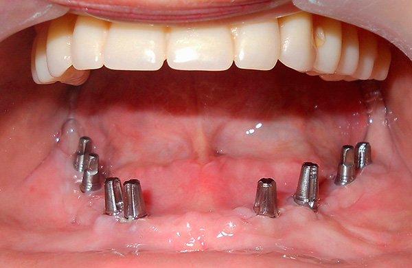 Um total de 8 implantes foram instalados.
