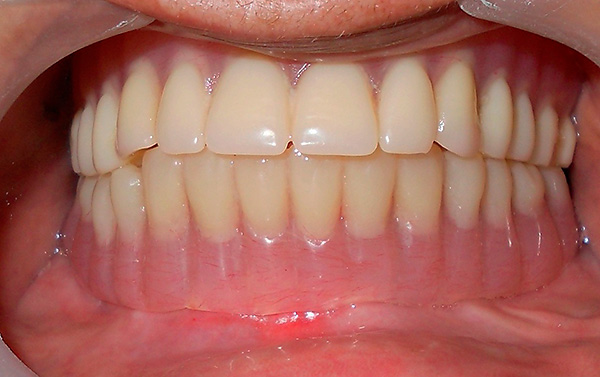 Uma prótese é instalada nos implantes - como resultado, a estética e a funcionalidade da dentição são restauradas.