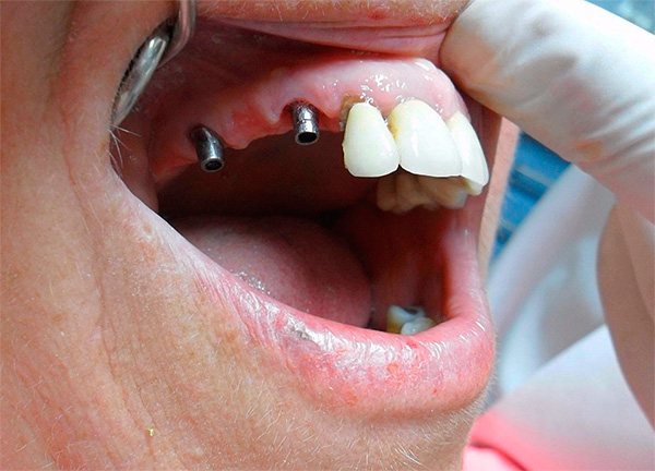 Vamos tentar descobrir que complicações às vezes surgem após implantes dentários e como reduzir o risco de vários problemas ...