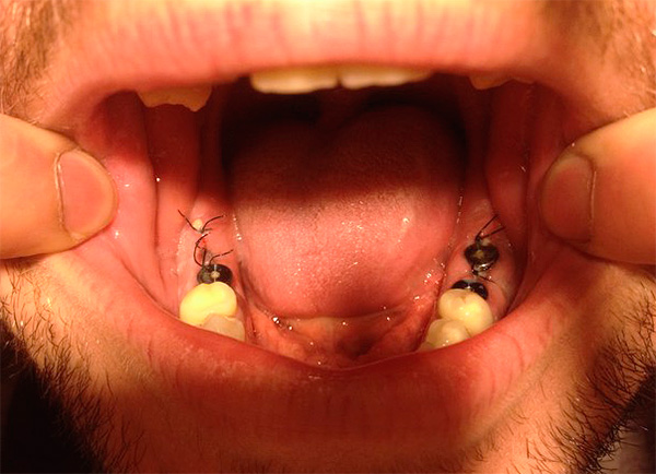 Às vezes, surgem complicações após a instalação dos implantes, e isso pode ocorrer tanto no primeiro dia após a cirurgia, como mesmo após vários anos.
