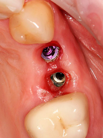 A periimplantite é uma inflamação na área de implantes dentários estabelecidos.