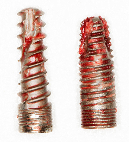 Implantes removidos da mandíbula