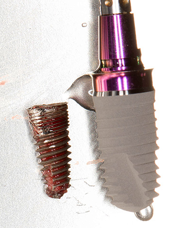 Após a remoção dos implantes rejeitados, é possível realizar repetidamente a implantação (algumas vezes após a preparação preliminar).