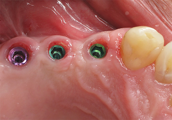 Hoje, a operação de implantação dentária é dispensada na maioria dos casos, sem complicações.