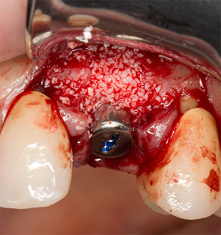 A foto mostra um exemplo de colocação de implantes juntamente com enxerto ósseo.