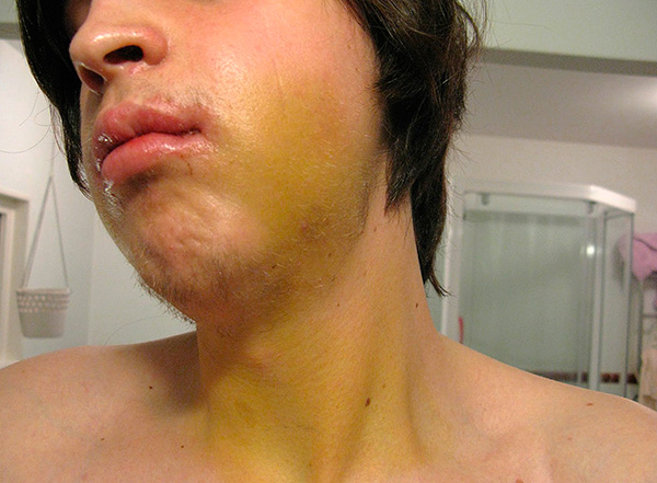 Às vezes, após a instalação de implantes no rosto e até no pescoço, um hematoma pode ser observado.