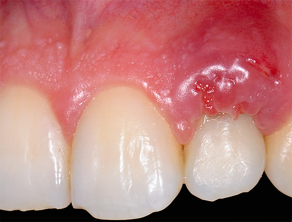 A foto mostra inflamação na área do implante de dente da mandíbula superior - infelizmente, às vezes ainda ocorrem complicações após o implante.