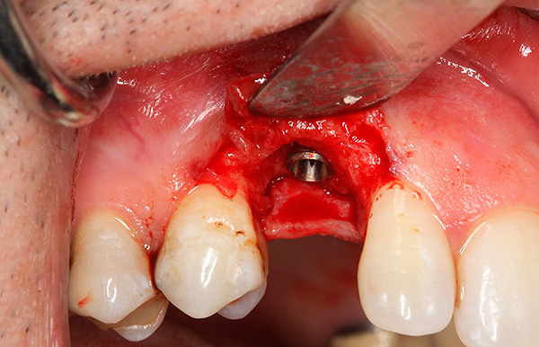 A operação de implante dentário geralmente é bastante traumática; portanto, o sangramento geralmente não pode ser dispensado.