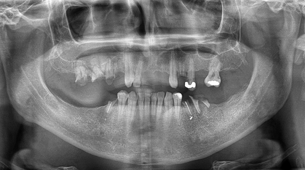 Esta imagem panorâmica mostra claramente que a distância dos dentes da mandíbula superior aos seios maxilares é muito pequena.