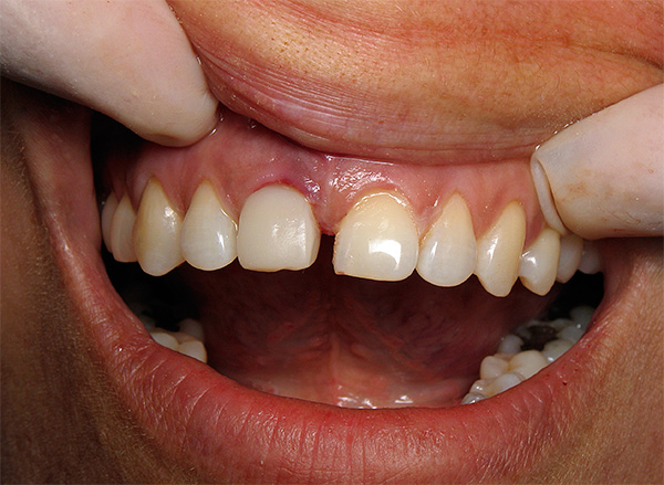 Vamos falar sobre os sintomas que podem acompanhar o processo de rejeição do implante dentário e, o mais importante, como reduzir o risco desse fenômeno desagradável ...