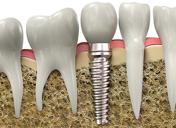 Vamos falar sobre os motivos que podem levar à rejeição de implantes ...