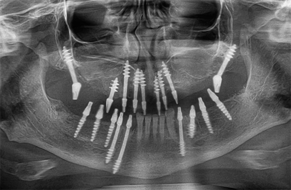 Implantes basais, como os clássicos, também são às vezes rejeitados.