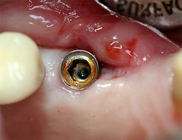 Corrosão para implantes dentários
