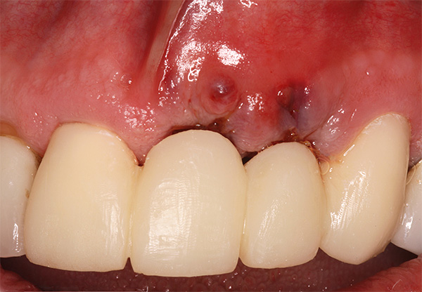 Com uma deterioração significativa na saúde geral, os problemas com implantes dentários podem começar muitos anos depois de serem instalados.