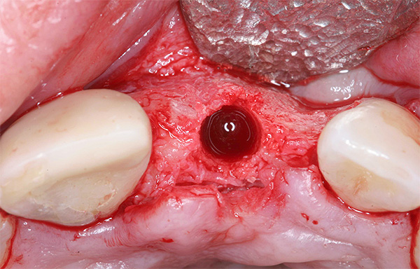 A foto mostra um exemplo de implantação repetida após a restauração do tecido ósseo do processo alveolar.