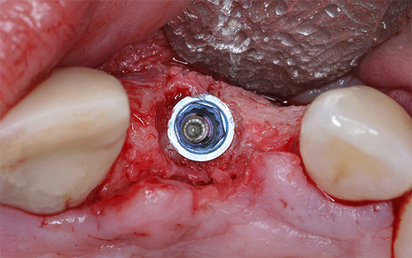 Um implante é implantado no osso restaurado.