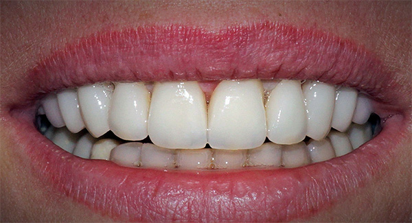 Existem algumas dicas simples para evitar muitos dos problemas associados à rejeição de implantes dentários ...