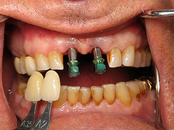 Periodontite e doença periodontal criam uma série de dificuldades para implantes dentários, mas nem tudo é tão desesperador quanto parece à primeira vista ...
