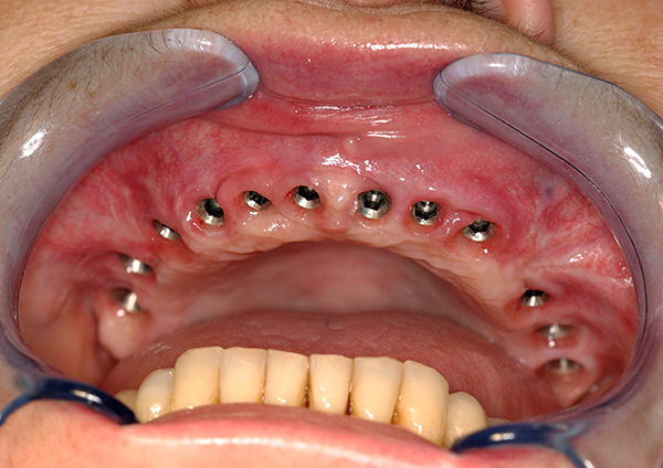 Depois que todos os dentes foram removidos, a implantação pode ser realizada.