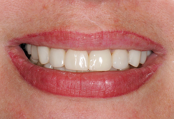O resultado da substituição de todos os pacientes e da falta de dentes por implantes é um sorriso bonito e uniforme e a capacidade de mastigar normalmente.