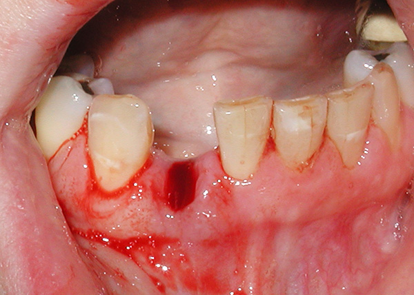 Com a periodontite, é muito perigoso deixar um espaço vazio na dentição sem atenção ...