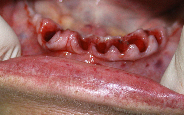 Nas formas severas de periodontite, muitas vezes são realizadas várias extrações dentárias (então os implantes podem ser substituídos em seu lugar).