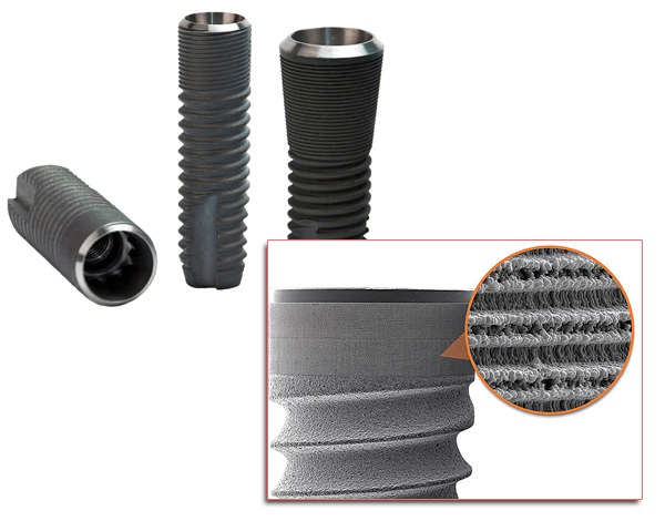 Os implantes de titânio têm uma superfície porosa especial, o que contribui para a fusão do material com o osso da mandíbula.