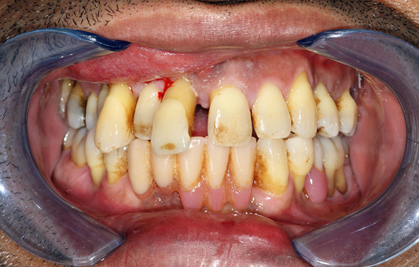 Dependendo da condição dos dentes, o plano de tratamento individual pode ser diferente ...