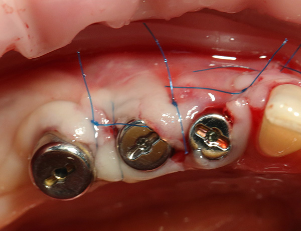 A ausência de focos de inflamação na área de implantes instalados reduz significativamente o risco de rejeição.