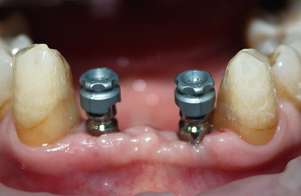 Hoje, existem várias tecnologias de implantação, bem como diferentes tipos de implantes, diferindo em preço e qualidade.