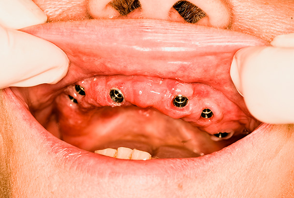 Mesmo que a condição dos dentes seja muito ruim, a implantação geralmente permite restaurar a beleza de um sorriso e a capacidade de mastigar alimentos normalmente.