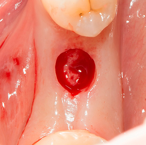 A incisão gengival mostrada na fotografia foi feita usando um mucótomo circular.