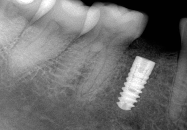 Não esqueça que, mesmo com implantes não cirúrgicos, apesar dos danos mínimos nas gengivas, você ainda precisará perfurar o osso da mandíbula para instalar um implante nele.