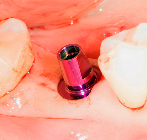 Embora a publicidade possa falar de um método não cirúrgico de colocação de implantes, na realidade, a operação ainda ocorre.