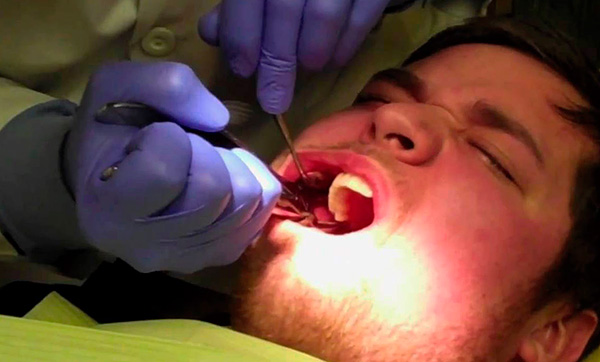 Se a extração dentária não for bem-sucedida, o médico poderá decidir recusar a instalação simultânea do implante.