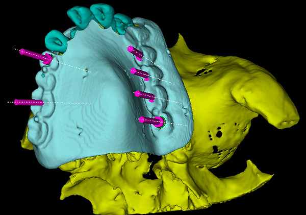 A modelagem 3D durante implantes dentários pode reduzir significativamente a probabilidade de erro médico.