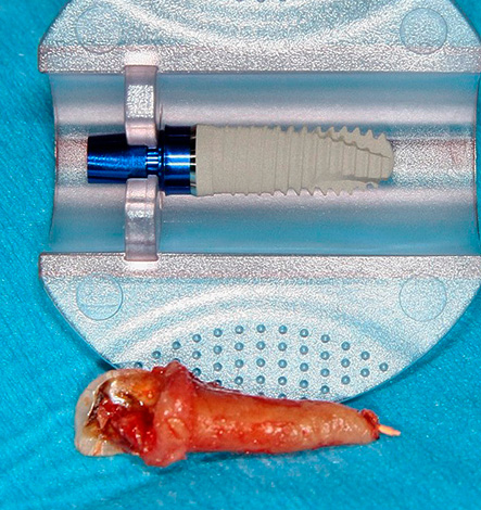 Durante o implante expresso, um implante dentário é inserido no orifício imediatamente após o procedimento de extração do dente.