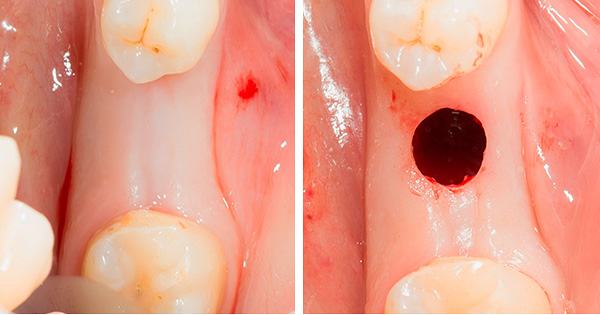 Com o chamado implante não cirúrgico de dentes, uma incisão gengival ainda é realizada - é simplesmente circular, não longitudinal.