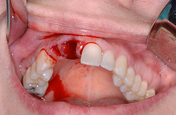 Um novo orifício após a extração do dente costuma ser bastante adequado para a instalação de um implante.