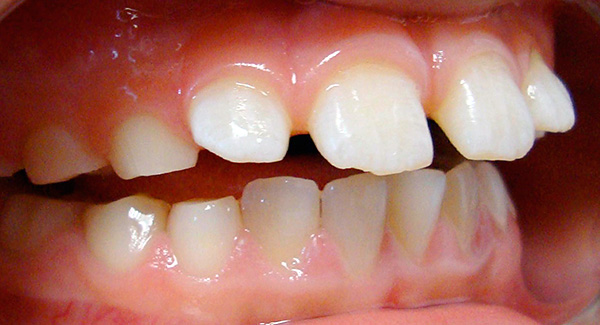 Com uma mordida aberta, um espaço sagital é formado entre os dentes.