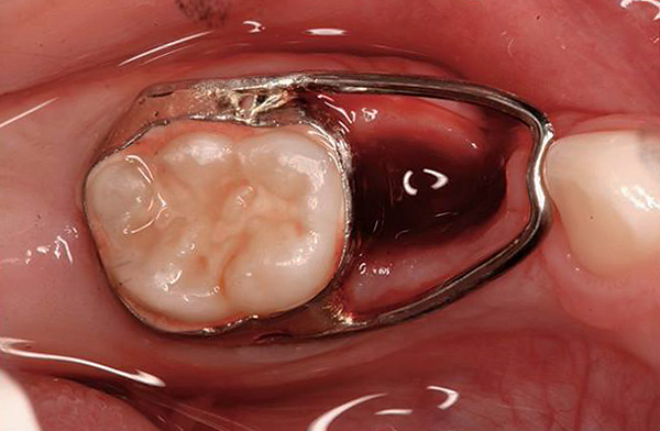 A foto mostra um exemplo de um dispositivo que salva um local na dentição devido à erupção de um dente permanente.
