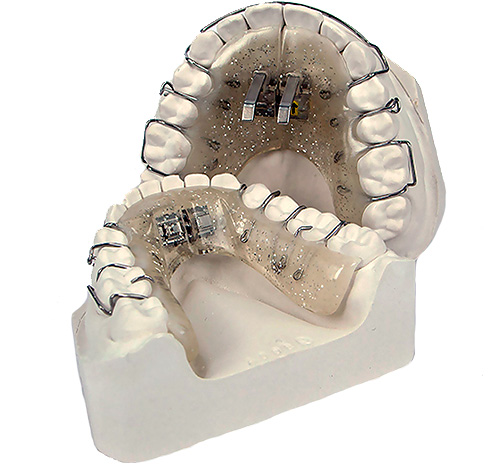 Aparafusadora removível para expandir e controlar o crescimento da mandíbula.