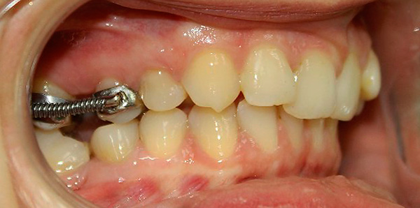 Ao corrigir uma mordida distal, um sistema de suporte especial com a ajuda de molas ajuda a mover os dentes 6 e 7 superiores para a posição traseira.